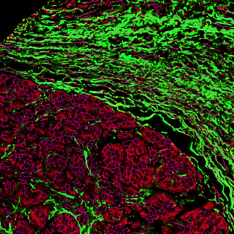 Pancreatic cancer TMA showing skeleton quantification